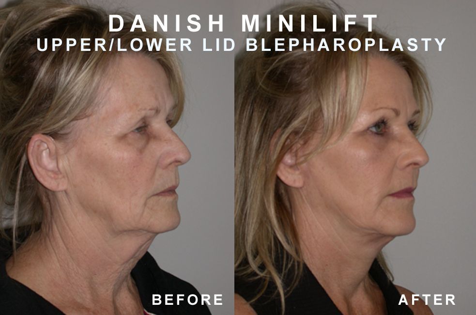 Before and after photos showing a woman's face. After a minilift and blepharoplasty, skin appears tighter.