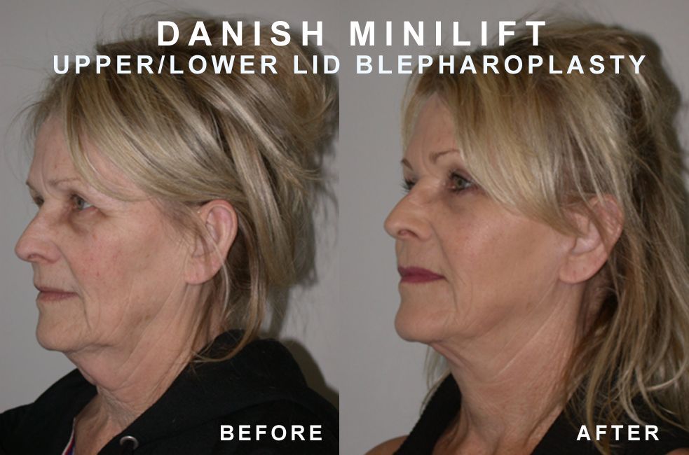 Side-by-side comparison: woman's face before and after a Danish MiniLift and upper/lower eyelid surgery; shows reduced wrinkles.