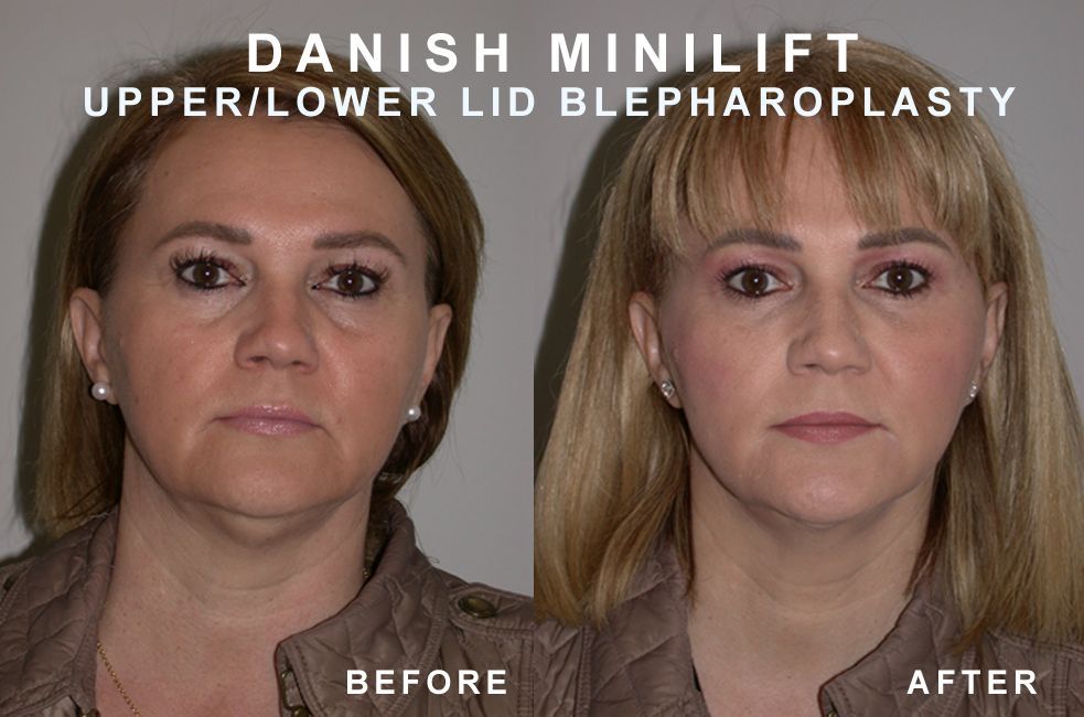 Side-by-side photos comparing a woman's face before and after a Danish Minilift and eyelid surgery.