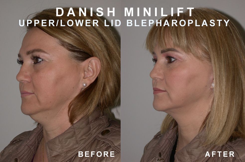 Side-by-side comparison of a woman's face before and after a Danish MiniLift and upper/lower eyelid blepharoplasty.