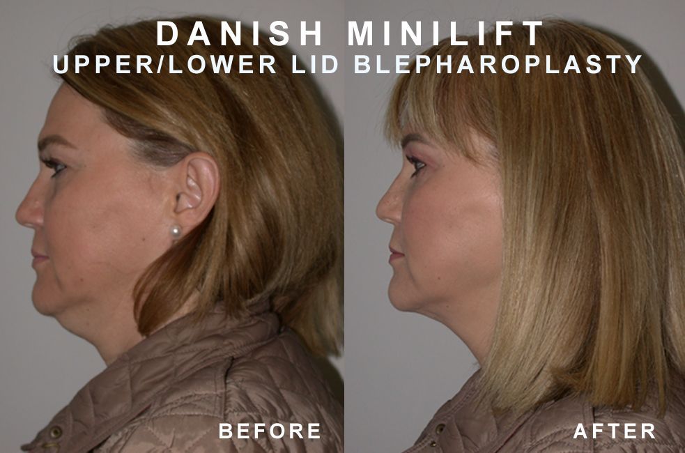 Before and after photos of a woman's face and neck after a Danish mini-lift and upper/lower lid blepharoplasty.