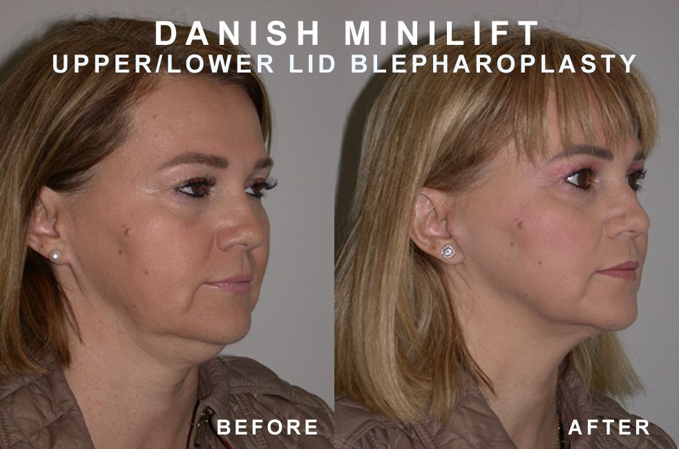 Before and after photos of a person's face after a Danish MiniLift and Upper/Lower Lid Blepharoplasty.