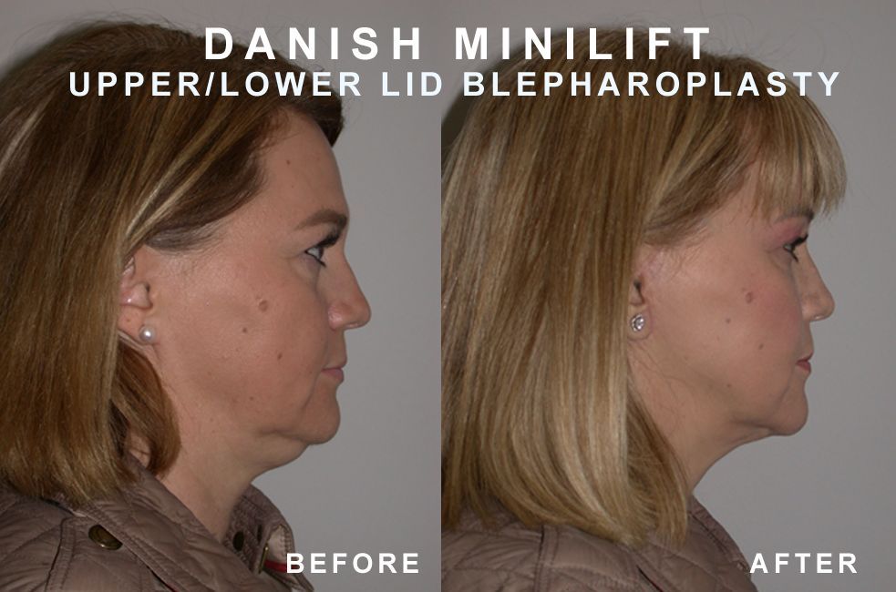 Side-by-side comparison: woman's face before and after Danish minilift and upper/lower lid blepharoplasty.
