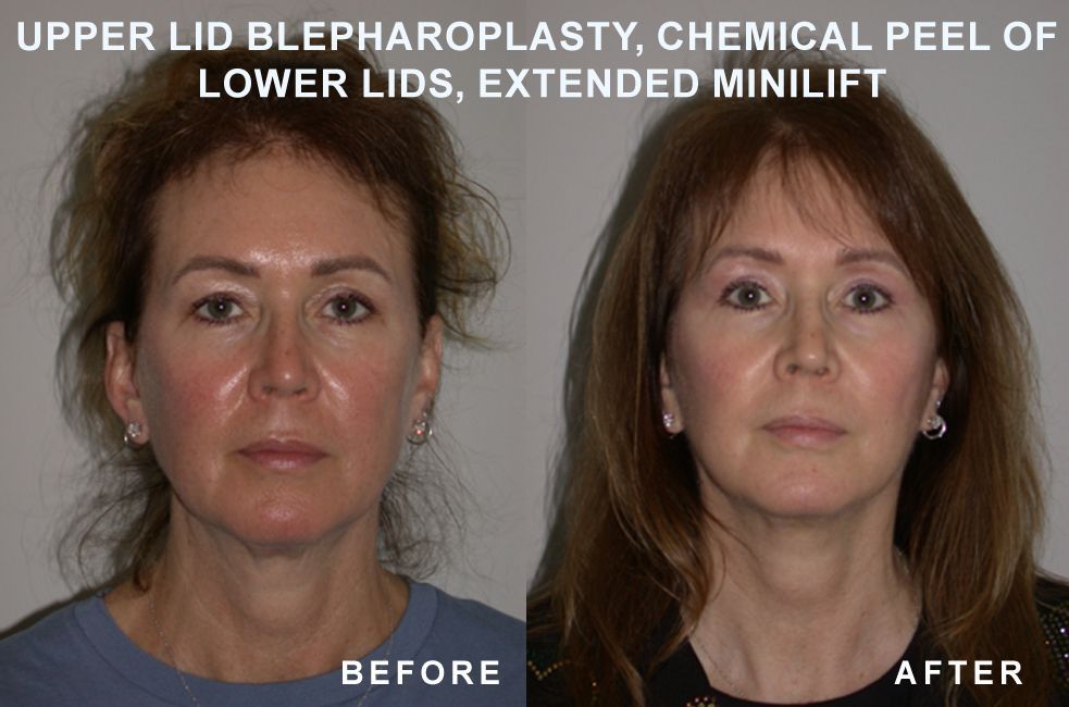 Before and after facial comparison: Upper lid blepharoplasty, chemical peel, extended mini lift.