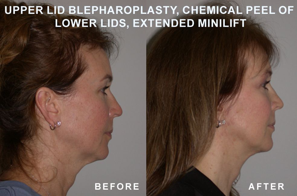 Side-by-side view showing before and after facelift results.  Includes upper lid blepharoplasty, chemical peel, and extended minilift.