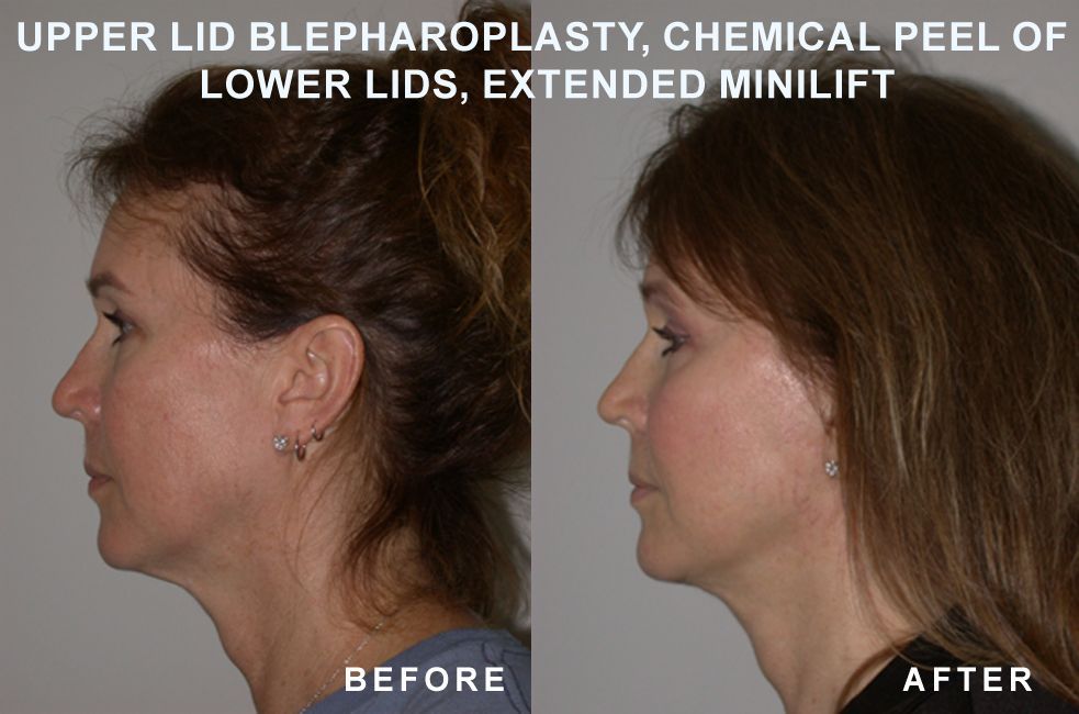 Side-by-side profile views of a woman's face. Before surgery shows sagging skin. After surgery, skin appears tighter.