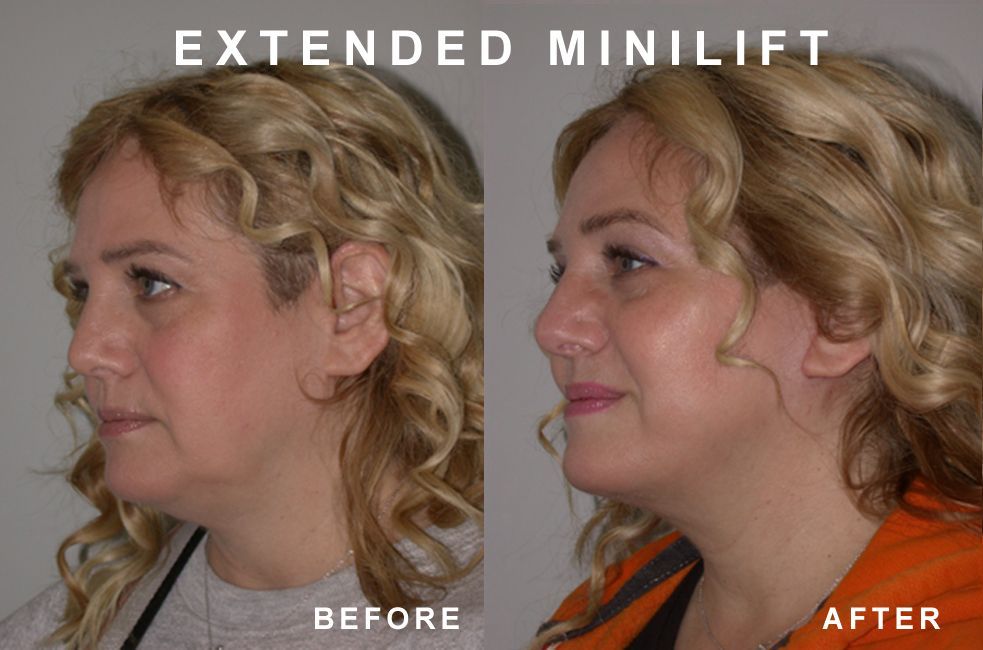 Before and after photos of a woman's face, showing results of an extended minilift procedure;  side profile.