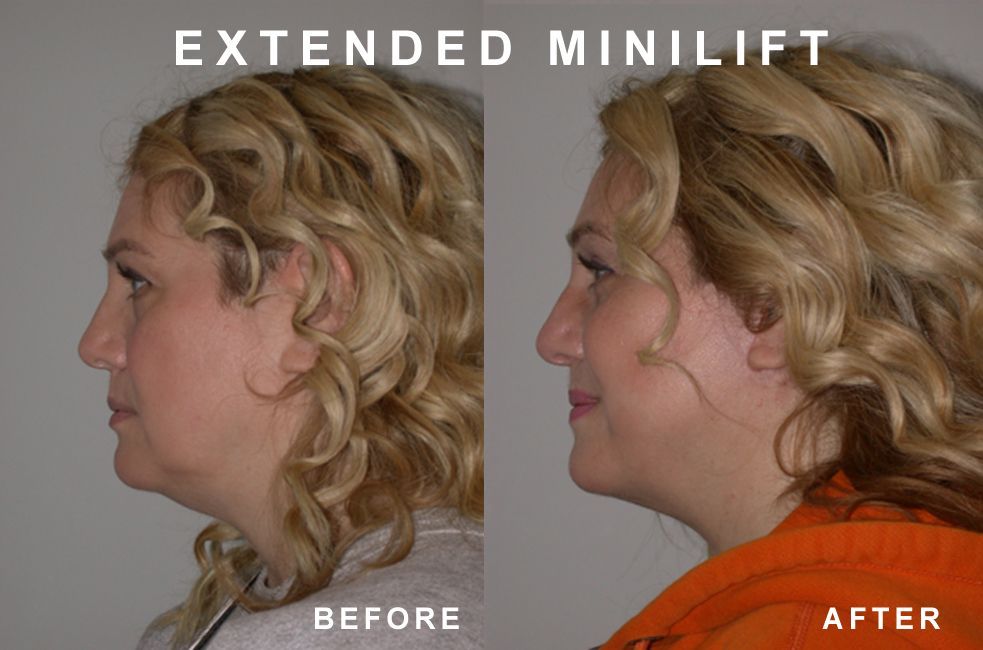 Side-by-side comparison of a person's profile before and after an extended minilift, showing a reduction in neck fullness.