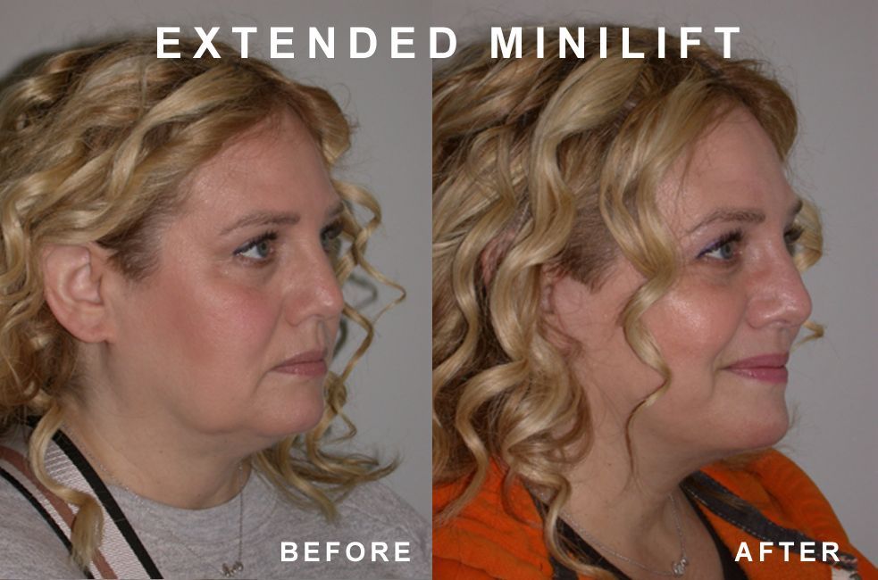 Side-by-side comparison of a woman's face before and after an extended minilift procedure; after shows tighter skin.