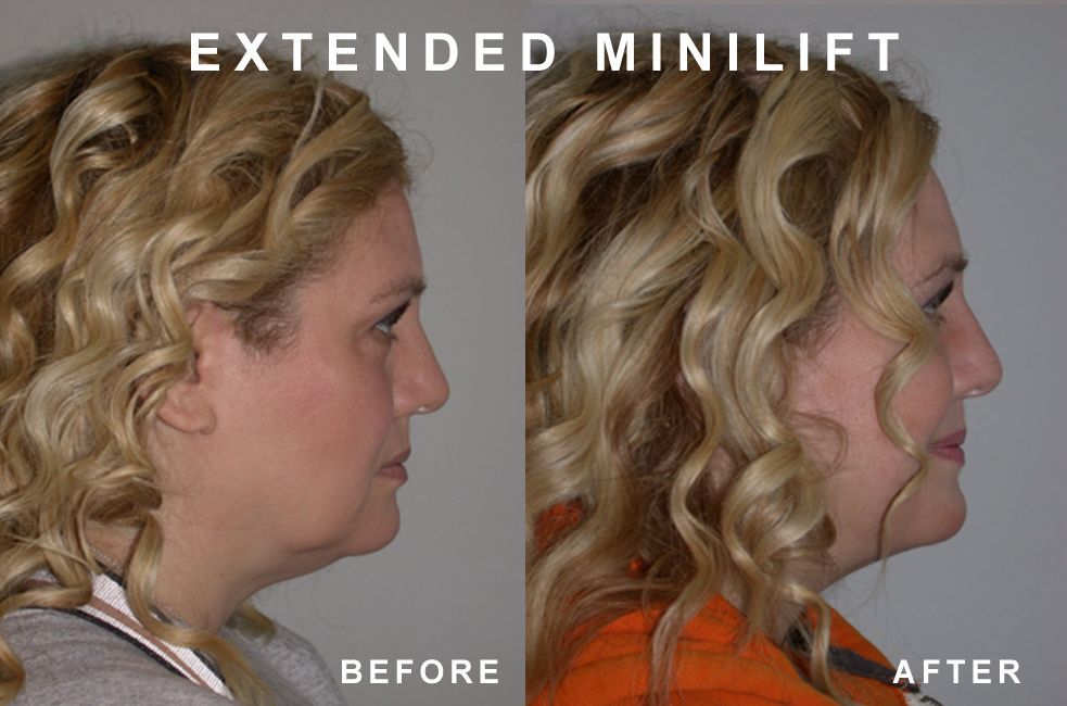 Side-by-side view showing a woman before and after an extended mini-lift. Her neck and jawline appear tighter in the after photo.