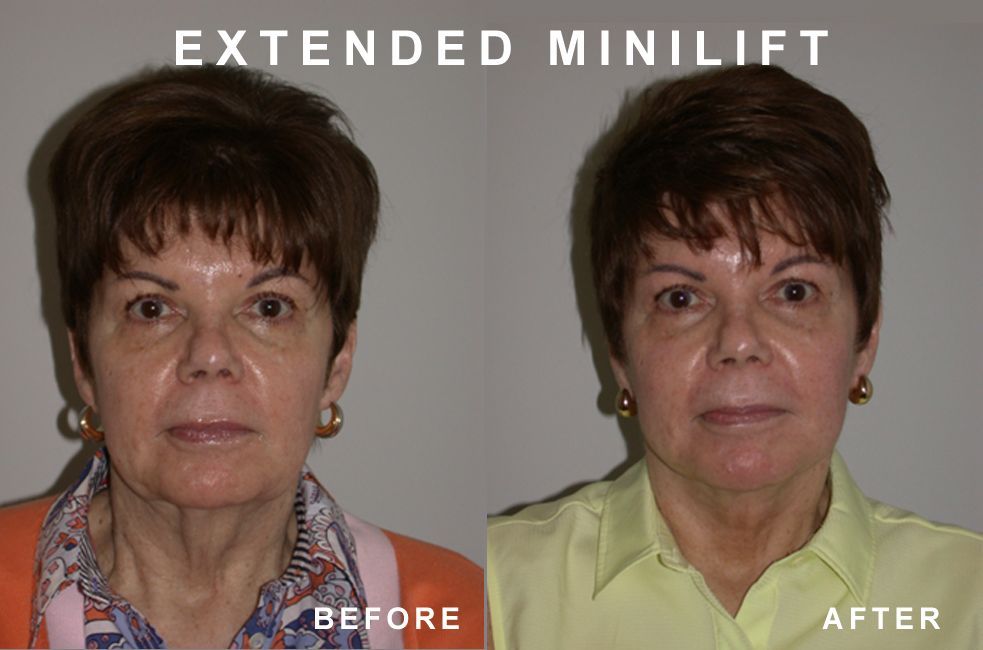 Before and after photos: Woman's face with less sagging skin after an 