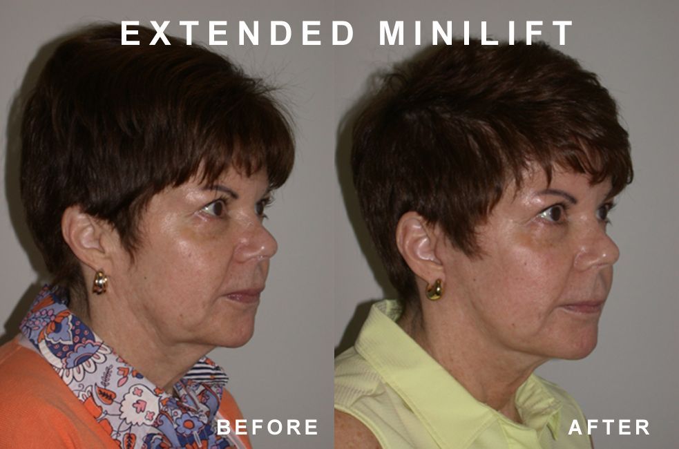 Before and after photo of a woman's face, showing a facelift's effect. Wrinkles reduced, skin smoother.