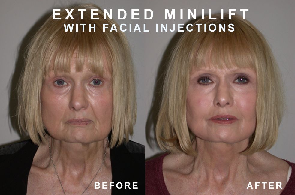 Before and after portraits of a woman, showing the results of an extended mini-lift and facial injections.
