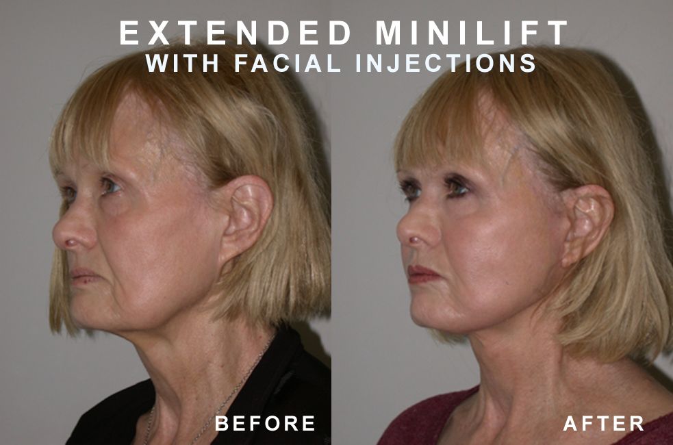 Side-by-side comparison of woman's face: before and after an extended minilift and facial injections.