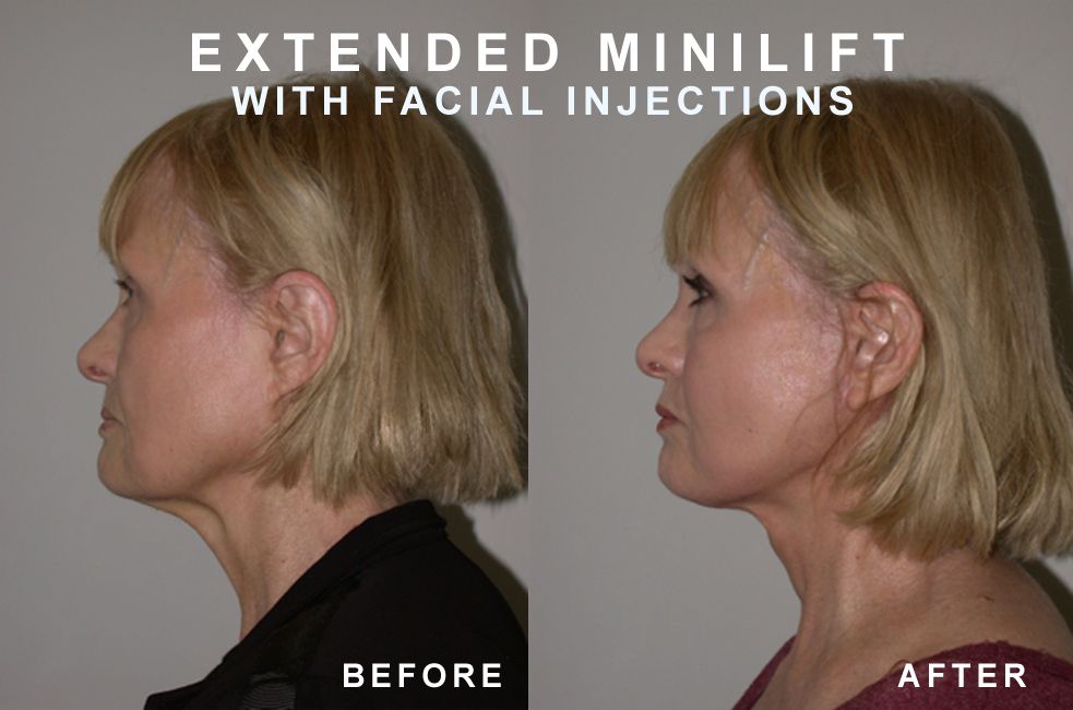 Before and after comparison of woman's profile, showing the effects of an extended mini-lift and facial injections.