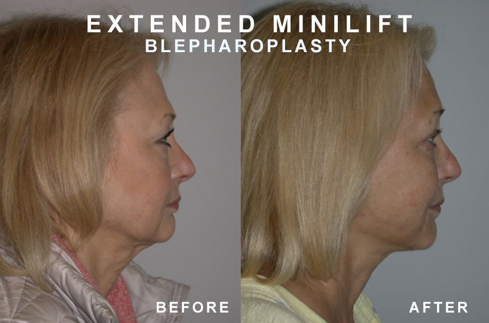 Side-by-side comparison: woman's profile before and after extended minilift and blepharoplasty, showing a rejuvenated appearance.