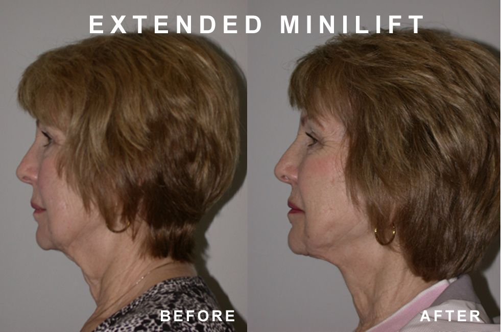Before and after photos of a woman's face, neck lift. The 