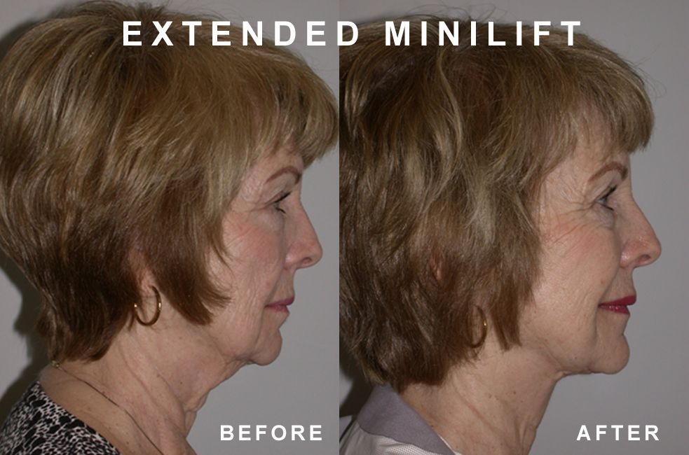 Comparison of a woman's profile before and after an extended mini-lift; neck and jawline appear tighter after surgery.