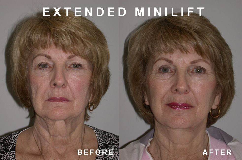 Before and after photos of a woman's face, showing a 