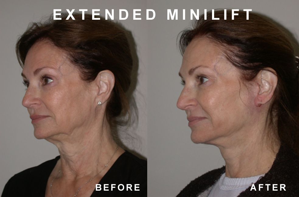 Before and after facial lift: woman with sagging neck and face, after lift, skin appears tighter.