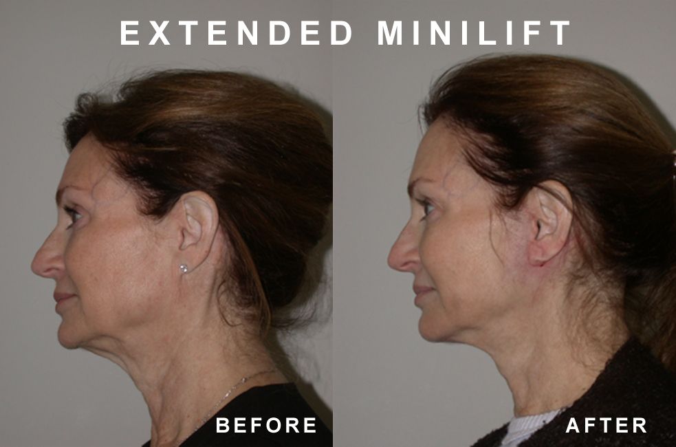 Side-by-side comparison: woman's profile before and after an extended mini-lift. Neck skin appears tighter in the 