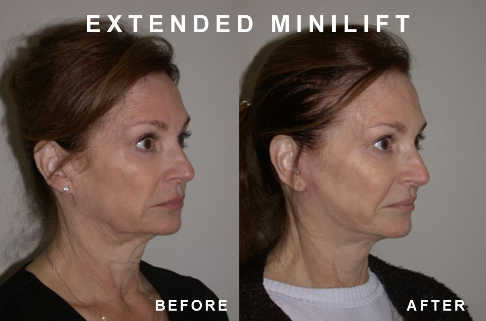 Side-by-side comparison shows a woman's face before and after an extended mini-lift, with tightened skin and reduced jowls.