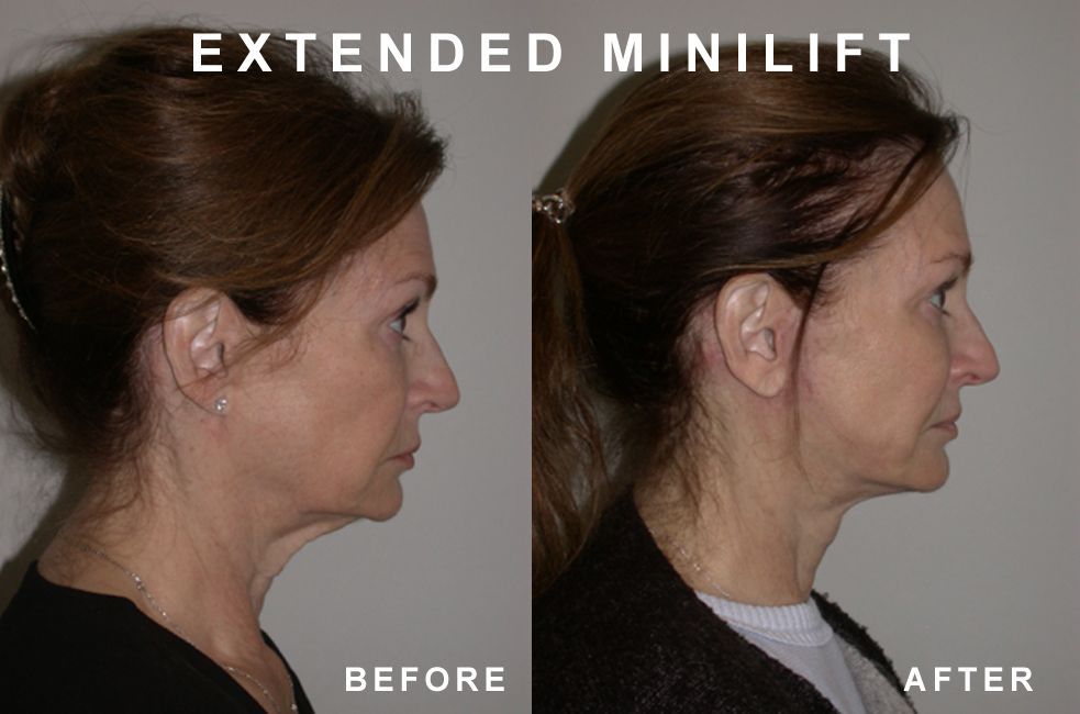 Side-by-side comparison of a woman's face before and after an extended minilift, showing a reduction in neck and jowl sagging.
