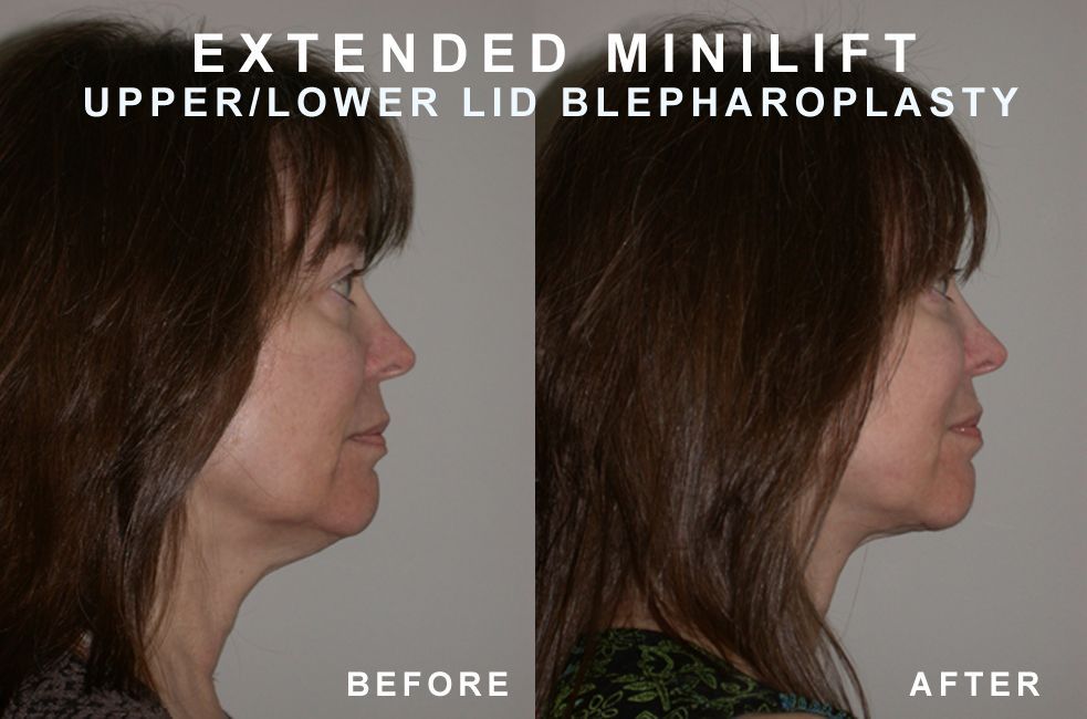 Side-by-side view, woman's face before and after extended minilift and blepharoplasty. Skin appears tighter, eyes lifted.