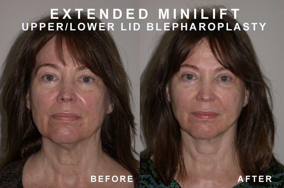 Side-by-side comparison of a woman's face before and after an extended mini-lift and blepharoplasty.