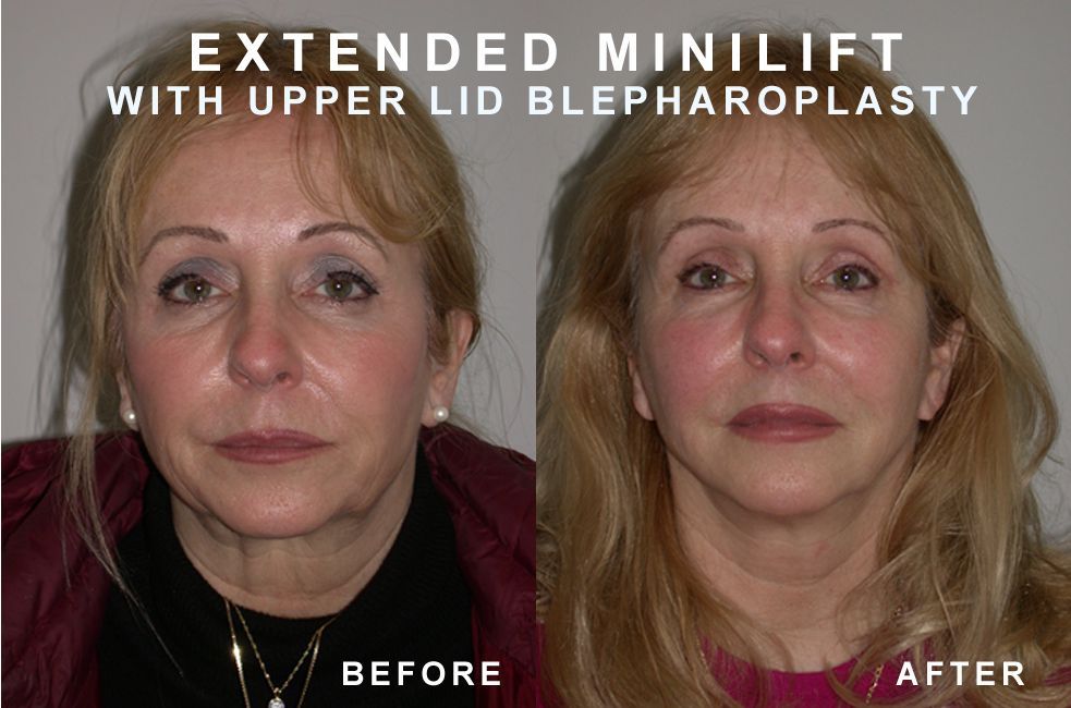 Side-by-side comparison: woman's face before and after extended minilift and upper eyelid blepharoplasty.