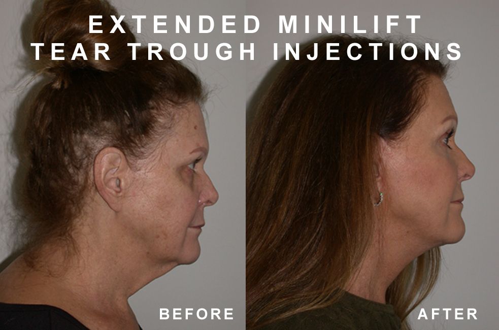 Before and after profile views of a person, showing the effects of an extended minilift and tear trough injections.