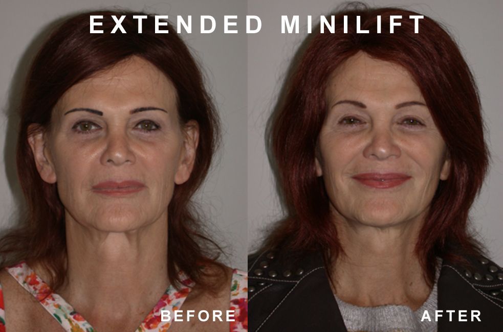 Before and after photos of a woman's face. Shows the effects of an extended mini-lift.