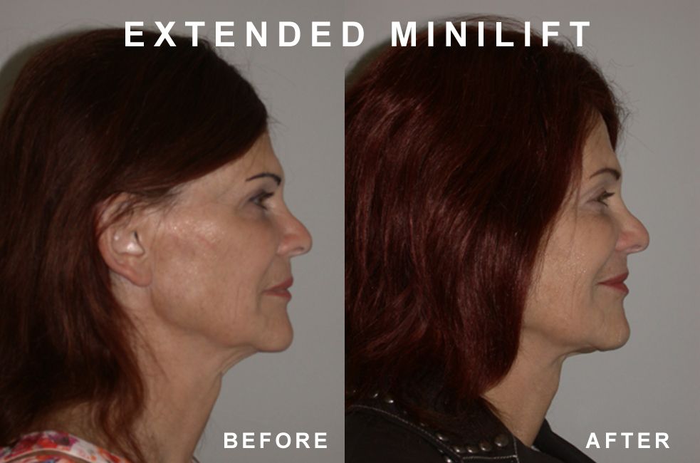 Side-by-side comparison of a woman's face before and after an extended minilift procedure, showing lifted skin and reduced sagging.