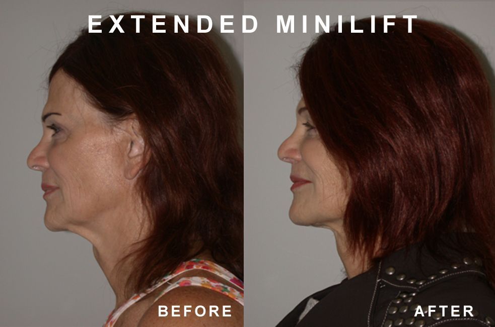 Before and after profiles of a woman's face, showing neck lift results.