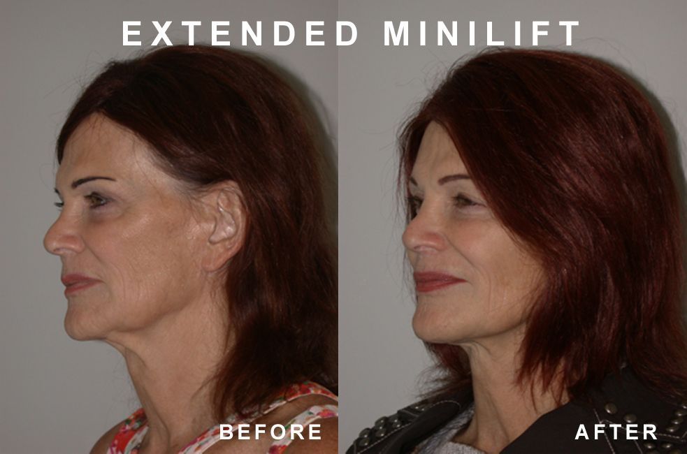 Comparison of a woman's profile before and after an extended mini-lift. Shows a visible tightening of the jawline and neck.