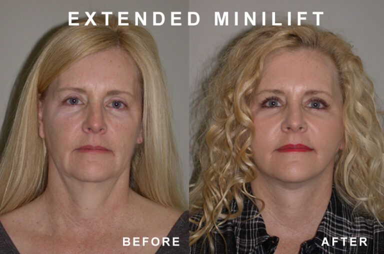 Before-and-after photos of a woman's face. The 
