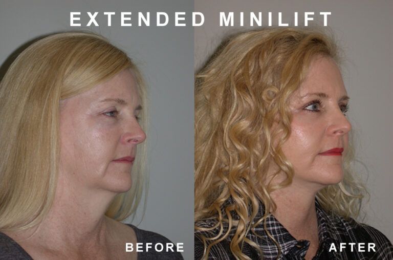 Side-by-side comparison. Woman before and after extended minilift, showing reduced jowls and neck lines.