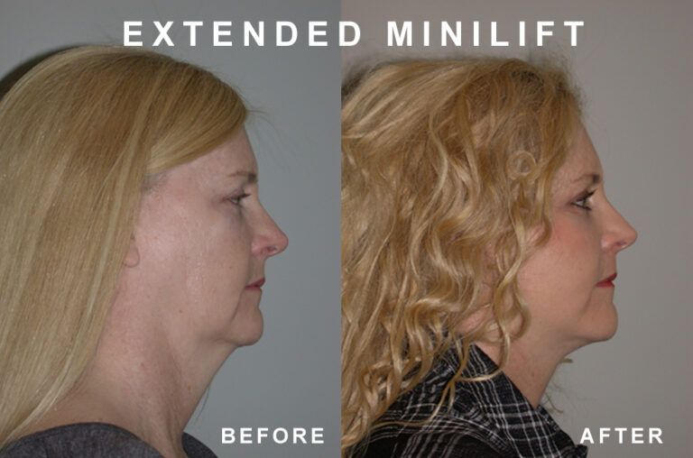 Before and after profile views of a woman's face, showing neck and jawline improvements from an extended minilift.