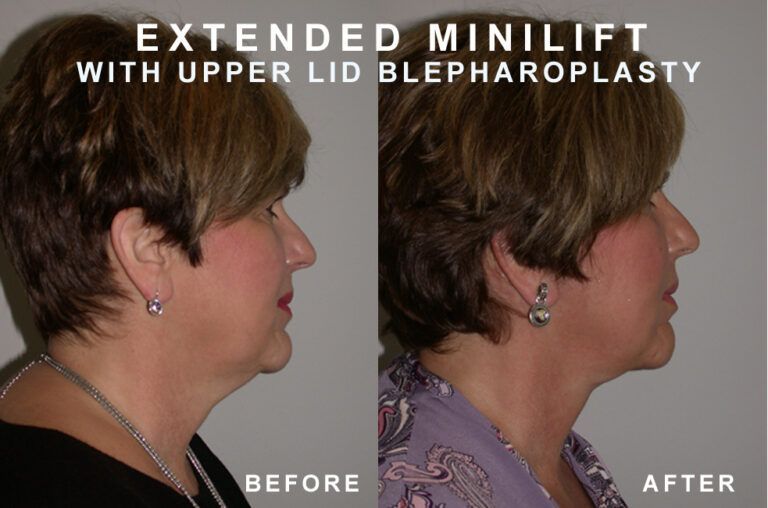 Side-by-side comparison: woman's profile before and after extended minilift with upper eyelid blepharoplasty.