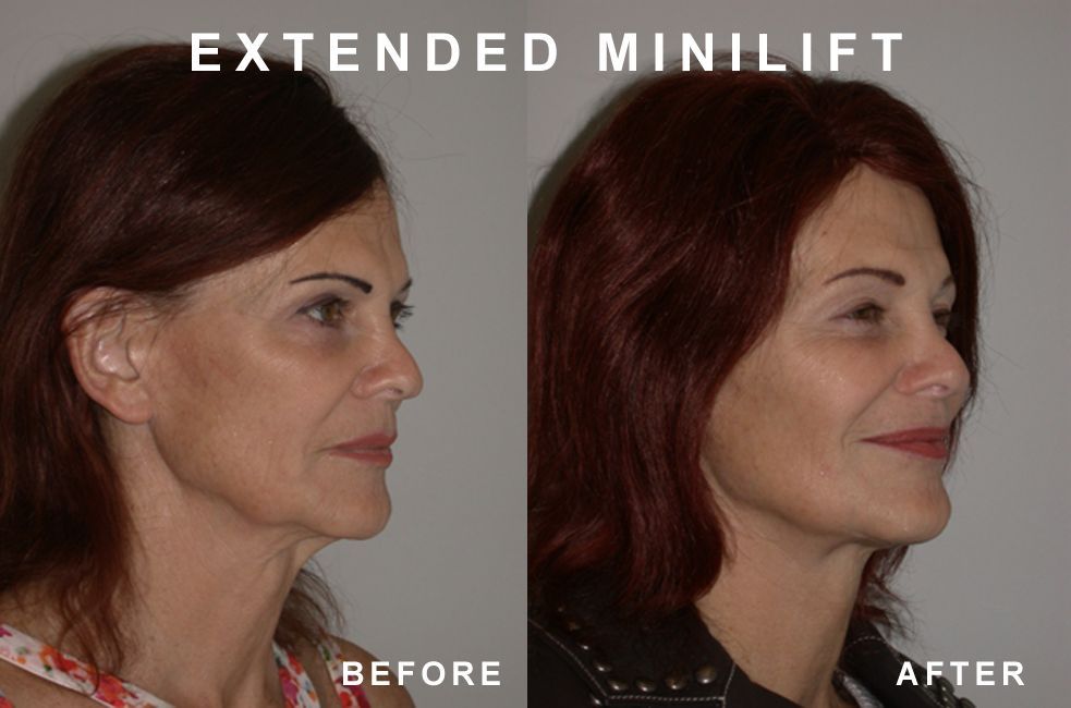Side-by-side comparison. Before and after view of a woman's face. After shows lifted skin.