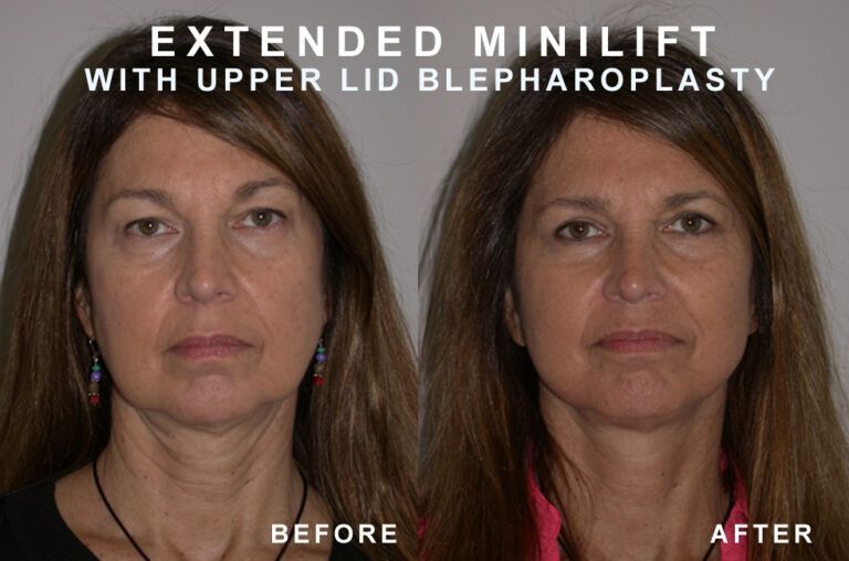 Before and after photos: Woman with sagging skin shows results of extended mini-lift and upper eyelid surgery.