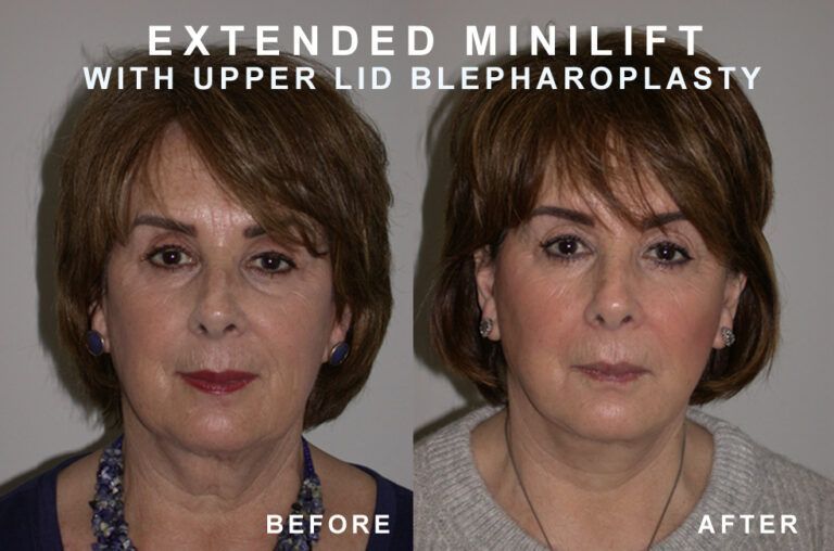 Before and after photos of a woman's face, comparing an extended mini-lift and upper eyelid blepharoplasty.