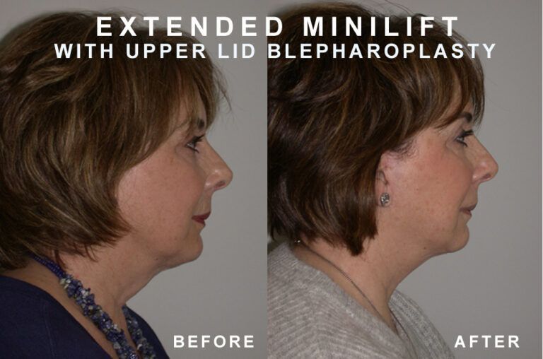 Side-by-side photos of a woman before and after an extended minilift and upper eyelid blepharoplasty, showing reduced neck and eyelid sagging.