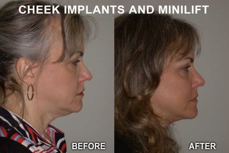 Before and after profile views of a woman. The 