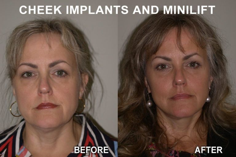 Before and after facial comparison: woman's face,  cheek implants and mini-lift. Left: before, slight jowls. Right: after, lifted appearance.