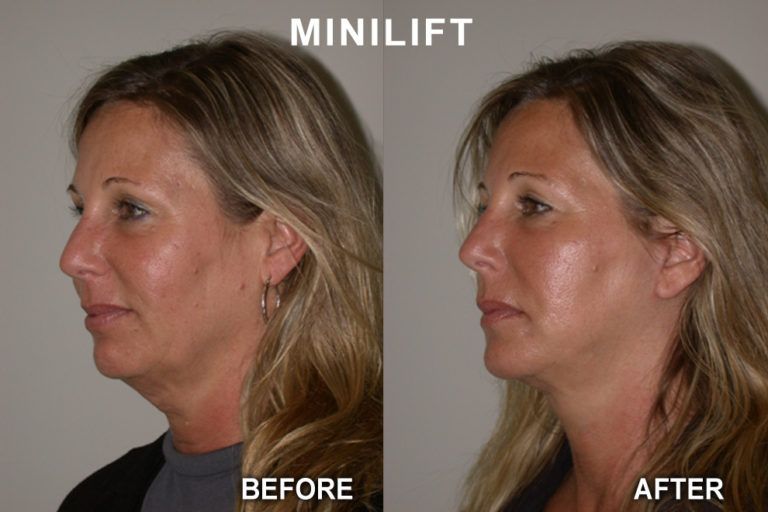Comparison of woman's profile: before and after a minilift, showing a reduction in neck and jawline sagging.
