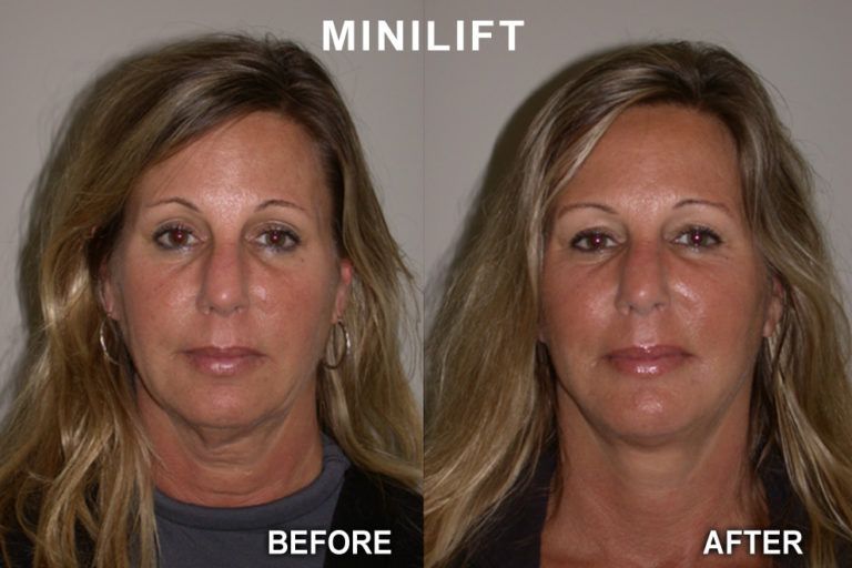 Side-by-side comparison of a woman's face before and after a minilift, showing reduced neck and jawline sagging.