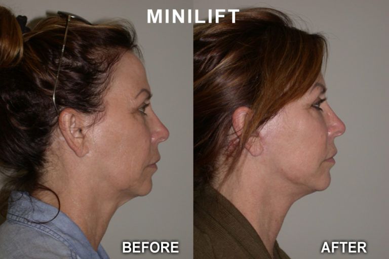 Side-by-side view: woman's face before and after minilift. After shows a tighter jawline, less sag.