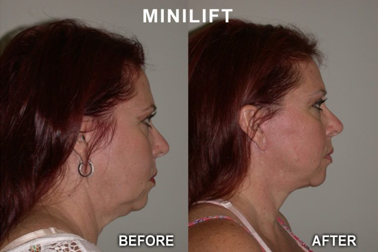 Side-by-side comparison of a woman's face before and after a minilift, showing reduced neck and jawline sagging.
