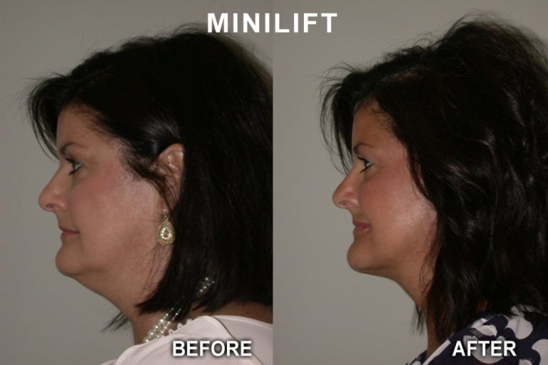 Side-by-side comparison of a woman's profile: before and after a minilift surgery, showing reduction of sagging skin.